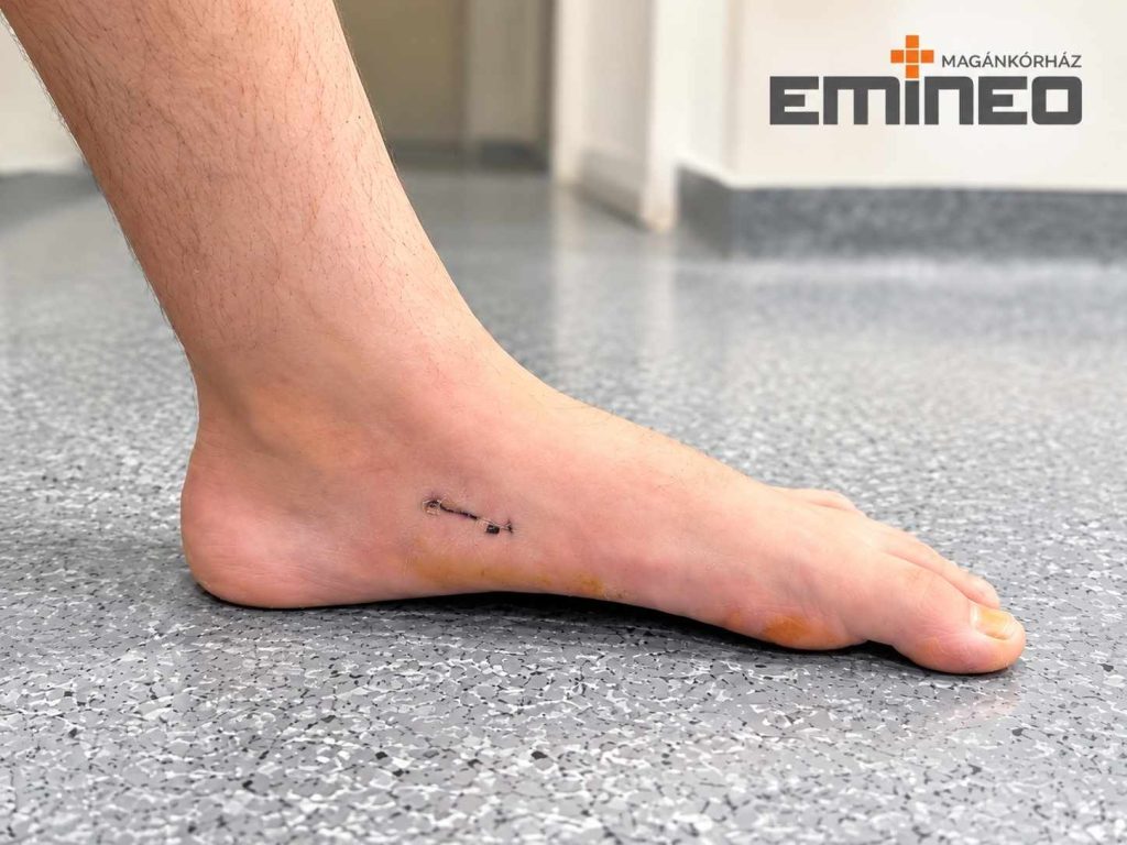 Lúdtalpasság műtéti kezelése az Emineo Magánkórházban